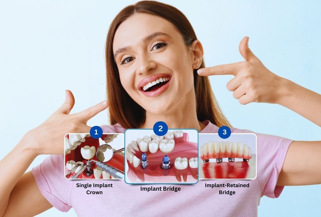 Dental Implants Tripoli Lebanon