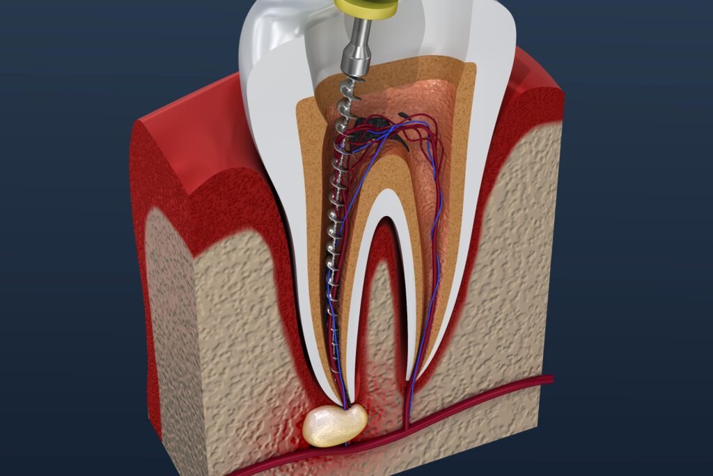 Root Canal Therapy - Dentist Tripoli