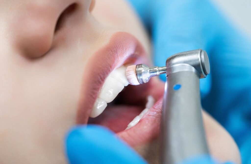 cleaning and polishing of teeth - Dentist Tripoli