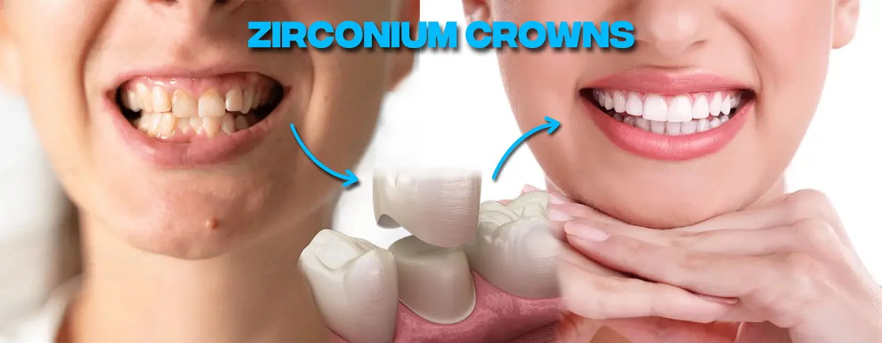 Zirconia Crown Before and After - Salhab Dental Center
